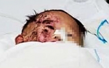 te vao dong rac dang dot ma khong ai biet be trai 4 tuoi o phu yen bi bong cuc nang phai doan chi