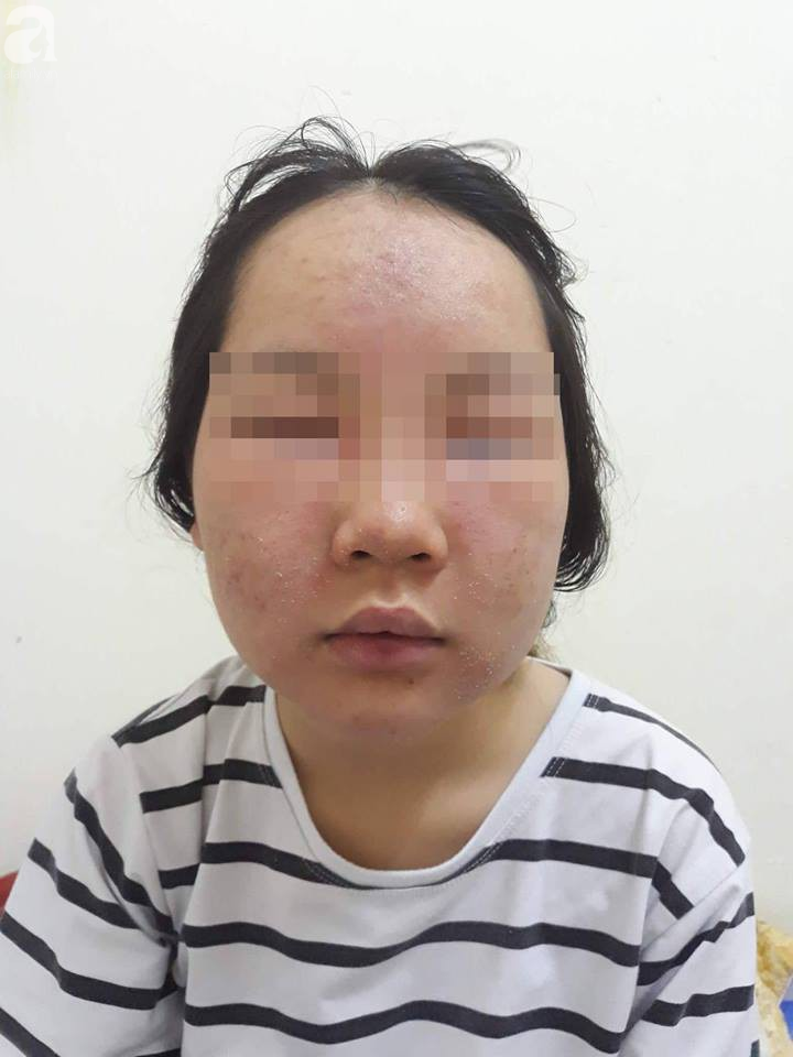 dung my pham dan toc mong da dep lot xac co gai 19 tuoi bi bien dang ca mat mat hip lai va sung vu kinh di