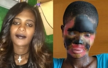 bi ga chong tan ac do axit nguoi phu nu hong hoan toan guong mat phai an va uong qua ong truyen