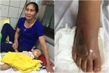Liên tiếp nhập viện vì bị rắn độc cắn, nhiều ca nặng có dấu hiệu hoại tử