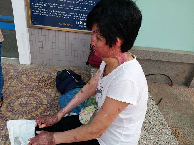 gap lai nguoi phu nu tung bi chong nhot tam xang thieu song toi khong con oan han chi mong co ngay doan tu voi con
