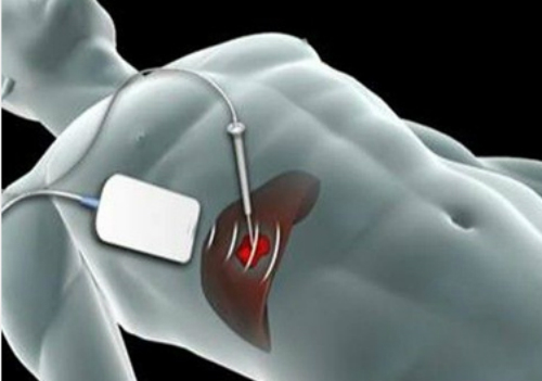 cat u gan bang vi song giup benh nhan chi nam vien 1 ngay