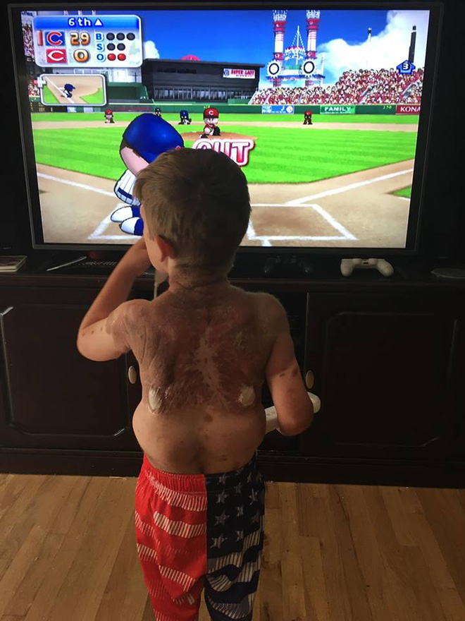 me dau don khi nhin thay 80 co the cua con so sinh phu day vet bot vay nhung do van chua phai la dieu toi te nhat