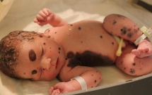 me dau don khi nhin thay 80 co the cua con so sinh phu day vet bot vay nhung do van chua phai la dieu toi te nhat