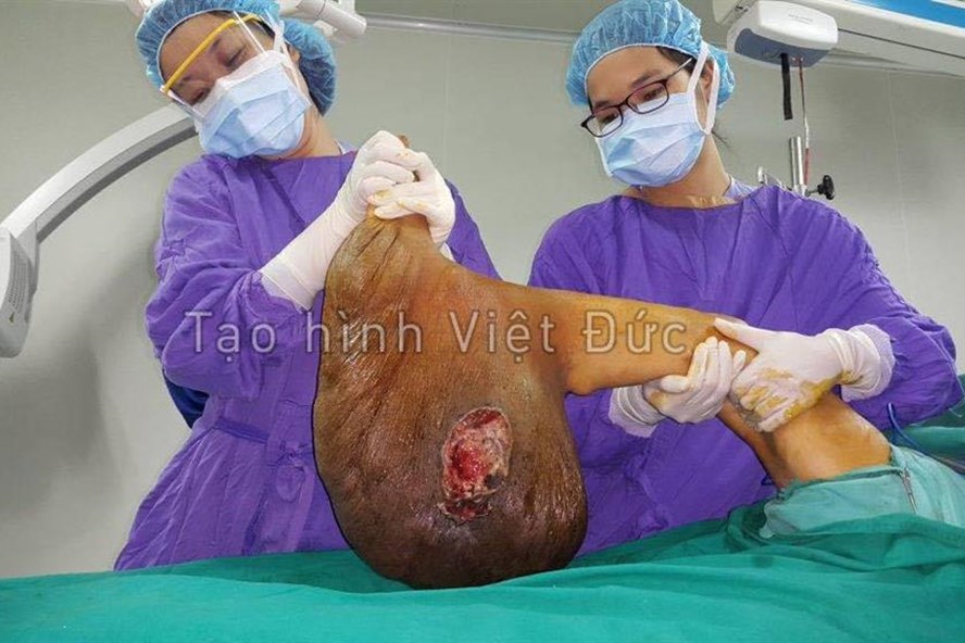 phau thuat thanh cong khoi u lon nang 10kg o chan benh nhan