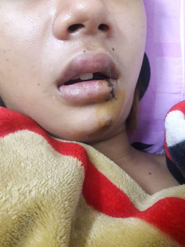 tphcm thieu nu 14 tuoi bi nhom thanh nien la mat chem len dau khong ro ly do phai khau gan 30 mui