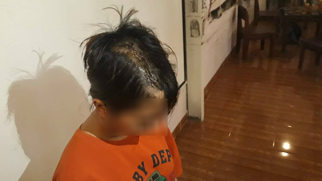 tphcm thieu nu 14 tuoi bi nhom thanh nien la mat chem len dau khong ro ly do phai khau gan 30 mui