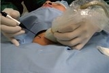 Nhẹ nhàng loại bỏ u tuyến giáp, không cần mổ