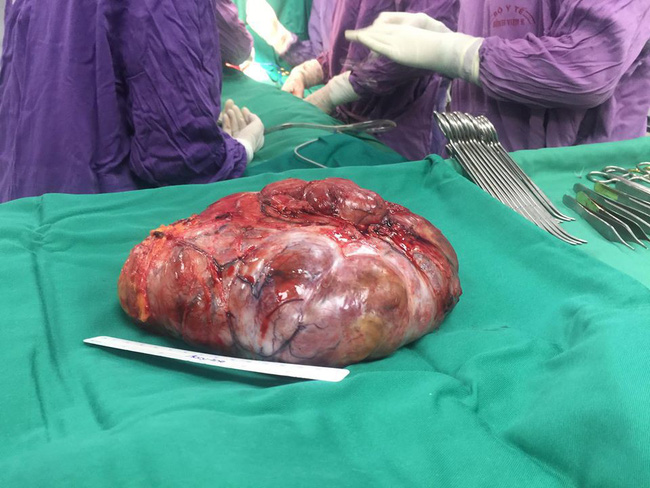 phau thuat cat bo thanh cong khoi u vu khong lo cho benh nhan o phu tho