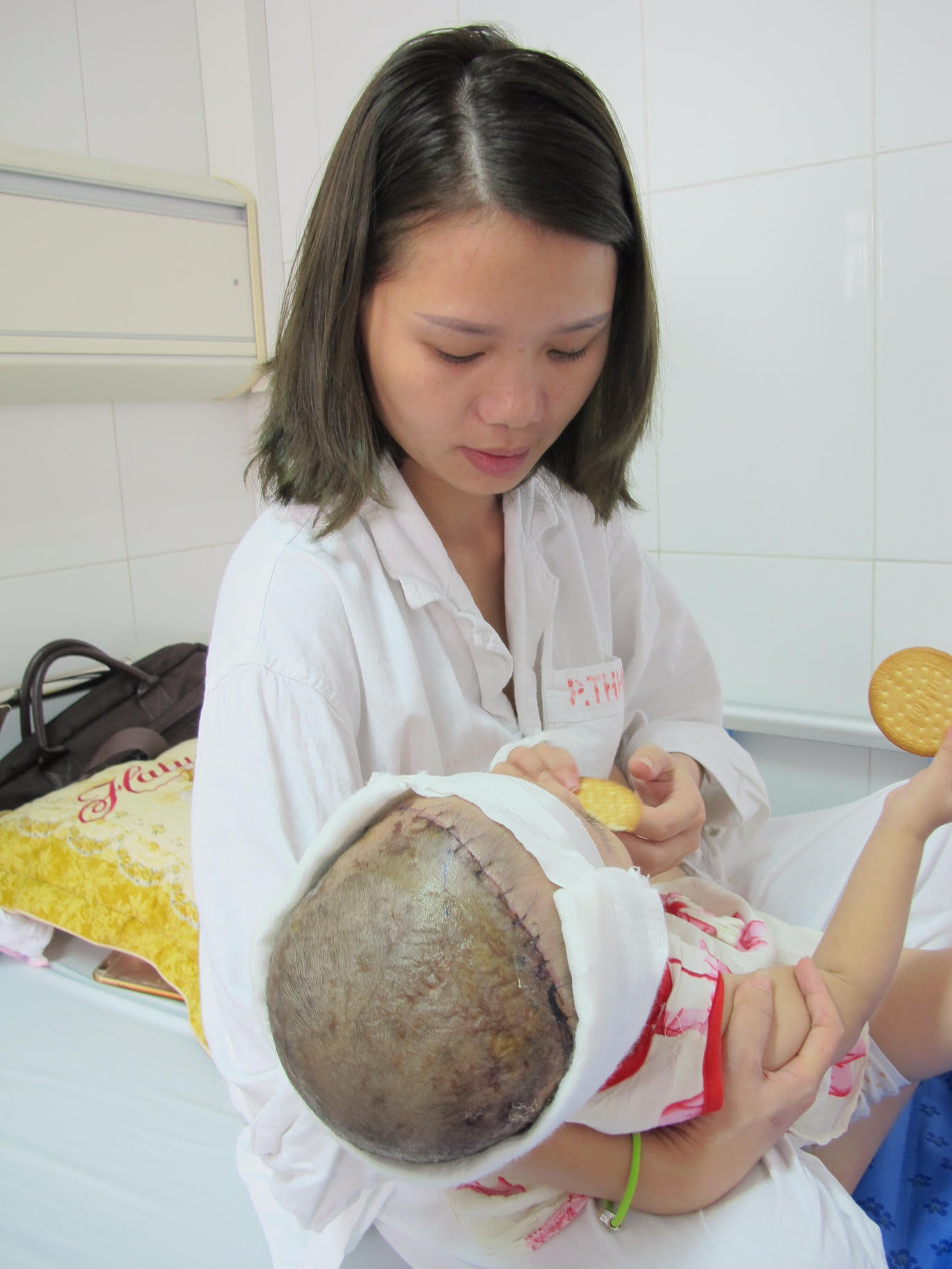 lan dau tien phau thuat thanh cong be 2 tuoi bi lot da dau