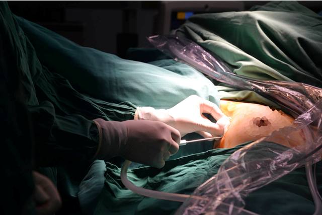 viet nam la nuoc dau tien thuc hien thanh cong ky thuat mo noi soi tuyen giap mot lo