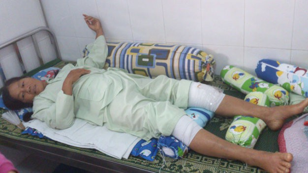 mo nham khong phai chuyen hiem