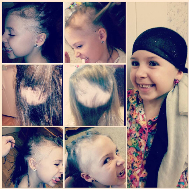 toc con vuong day luoc khi chai me nghi ngo can benh nay va day la chan doan chinh xac cua bac si