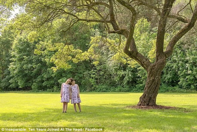 11 nam thang tram cua cap song sinh dinh lien phan dau tung duoc bac si du doan chi song khong qua 1 ngay