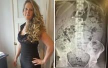 noi tang nguoi phu nu bi nhan chim trong chat thai den muc nghet tho chi vi mot so suat trong phau thuat