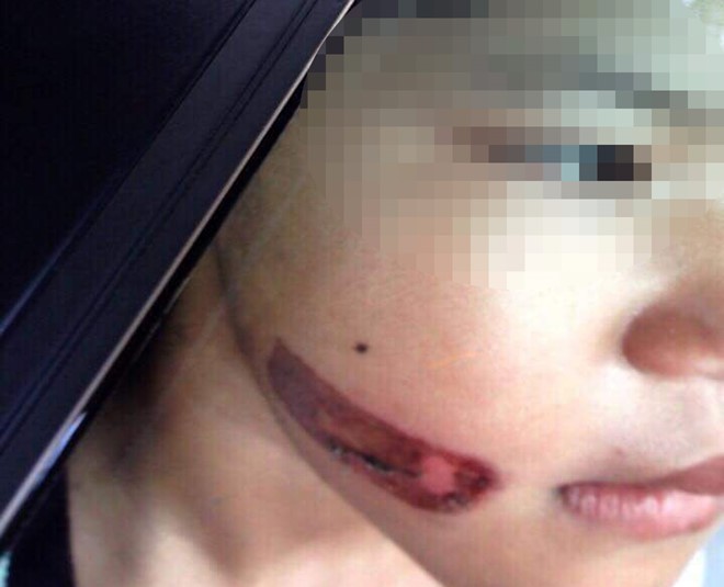 vu be gai nghi bi gi sat nung vao nguoi da co ket qua giam dinh cong an khoi to vu an