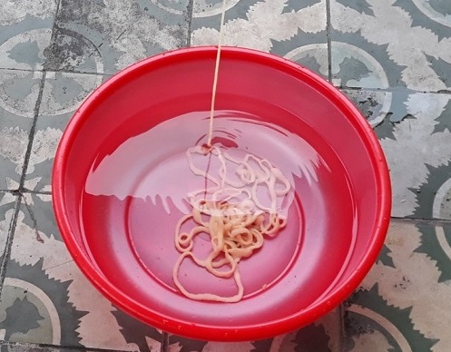 benh vien y hoc co truyen hue xo thanh cong san xo mit dai khoang 10m o co the nguoi nhieu nam