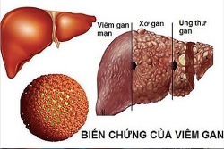 Ung thư gan là gì? Nguyên nhân, triệu chứng và cách điều trị ung thư gan