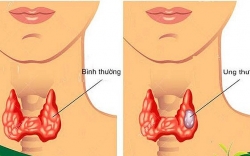 Ung thư tuyến giáp là gì? Nguyên nhân, triệu chứng và cách điều trị ung thư tuyến giáp