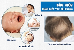 Bệnh còi xương ở trẻ em, những điều nên biết
