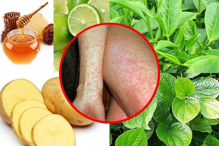 di ung thoi tiet cach phong ngua va dieu tri hieu qua