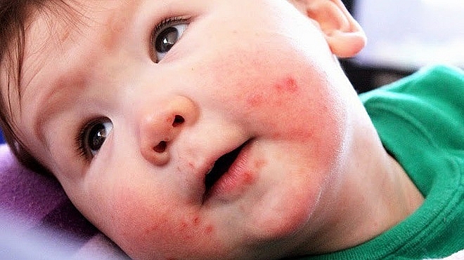 cach phong tranh va dieu tri hieu qua benh tay chan mieng o tre