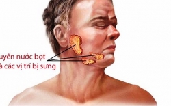 Bệnh quai bị và những điều cần biết