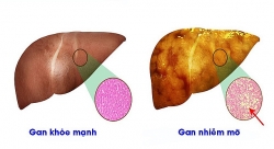 Cải thiện tình trạng gan nhiễm mỡ bằng thực phẩm?