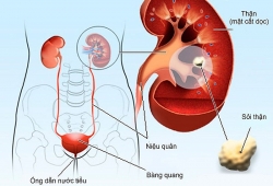 Bấm huyệt giúp hỗ trợ điều trị bệnh sỏi thận