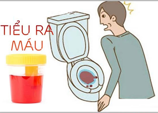 Tiểu máu là gì, nguyên nhân triệu chứng và cách chữa trị?