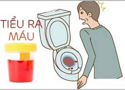 Tiểu máu là gì, nguyên nhân triệu chứng và cách chữa trị?