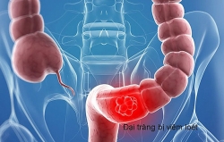 Điều trị bệnh viêm đại tràng bằng phương pháp bấm huyệt