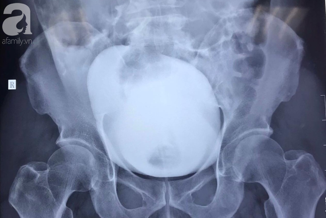 nhin tieu tu vung tau ve tphcm nguoi dan ong truot chan te vo bang quang