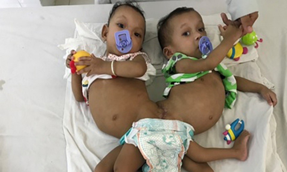 bo cua hai be gai dinh lien o binh phuoc con toi dep hon ca hoa hau
