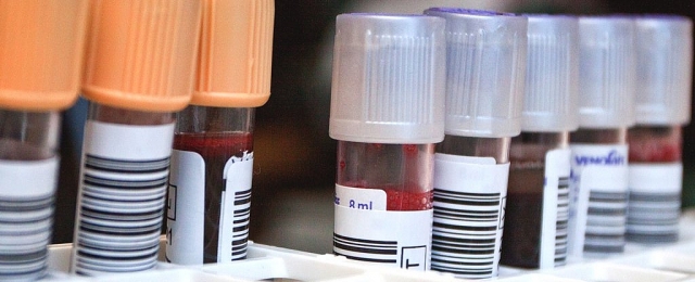 Đằng sau ba trường hợp bệnh nhân được chữa khỏi HIV dang sau ba truong hop benh nhan duoc chua khoi hiv