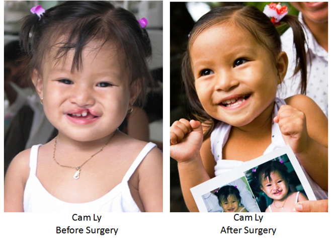 vinh danh operation smile 30 nam trao hang van nu cuoi